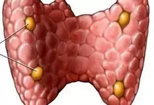 甲状腺腺瘤.jpeg 甲状腺腺瘤.jpeg